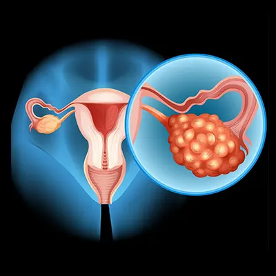 PCOD Treatment in Bhiwandi